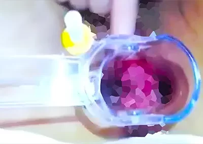 ！？これは何名器と言えば…？ 中に崩れた明太子の様なものが二個入ってるクスコ使用有料ライブチャット動画